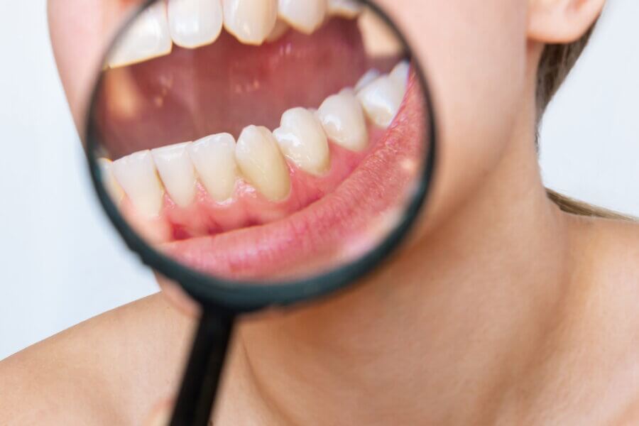 What Plaque and Tartar Really Do to Your Teeth
