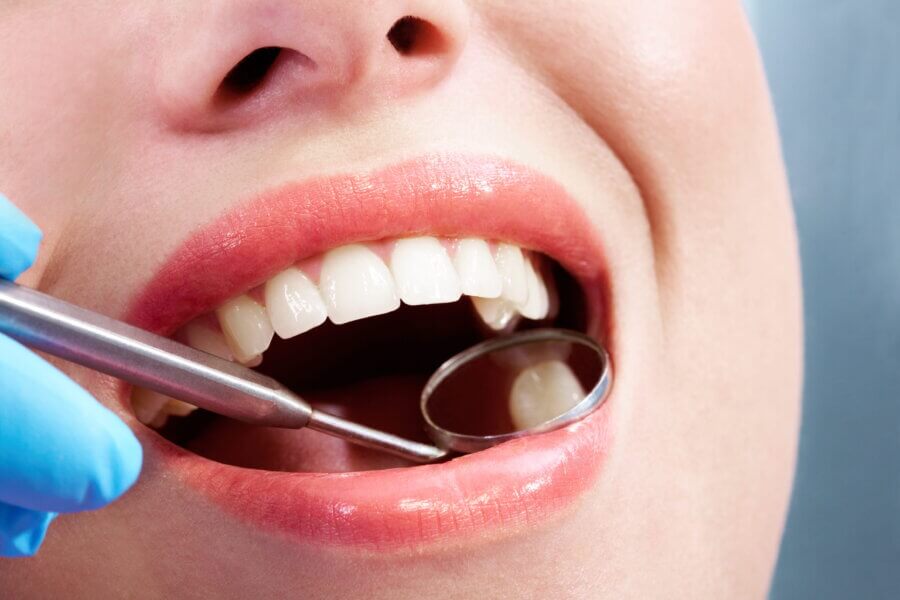 When Old Fillings Need to Be Replaced